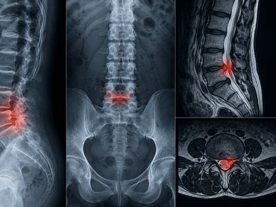 Hernia de disc: simptome, diagnostic, rolul evaluării imagistice și recuperare prin protocoale specifice